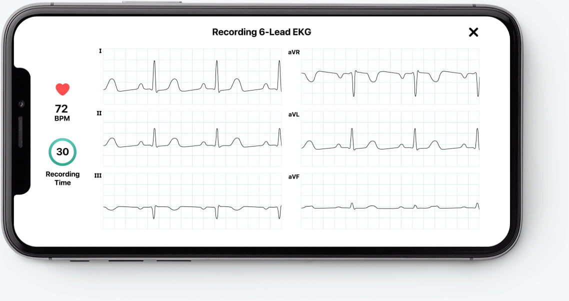 AliveCor KardiaMobile 6L Wireless 6-Lead EKG Smartphone Detects AFib or  Normal